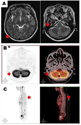 Multiple myeloma with isolated central nervous system relapse after autologous stem cell transplantation: A case report and review of the literature